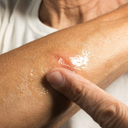 Fascynujący proces gojenia ran